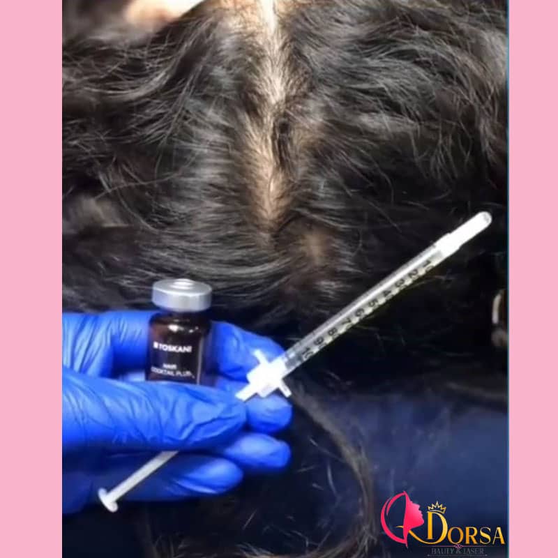 درمان ریزش مو با مزوتراپی