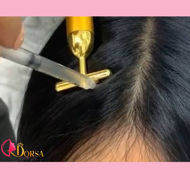 بهترین دکتر مزوتراپی مو در شمال تهران