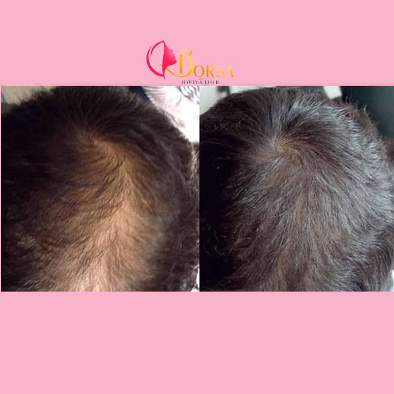 مرکز مزوتراپی مو در شمال تهران