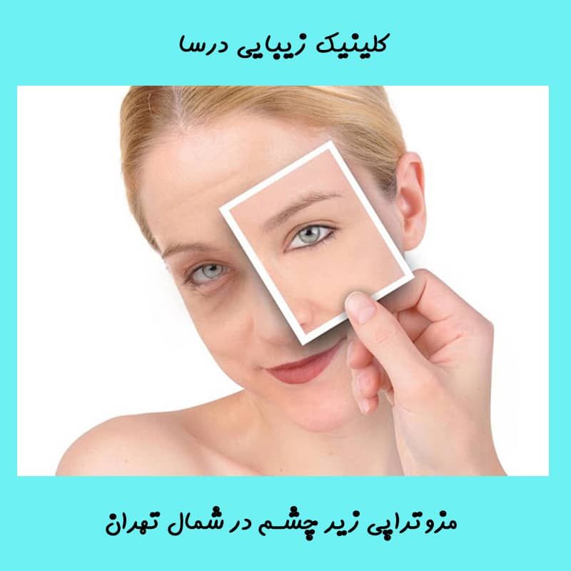 مزوتراپی زیر چشم در شمال تهران