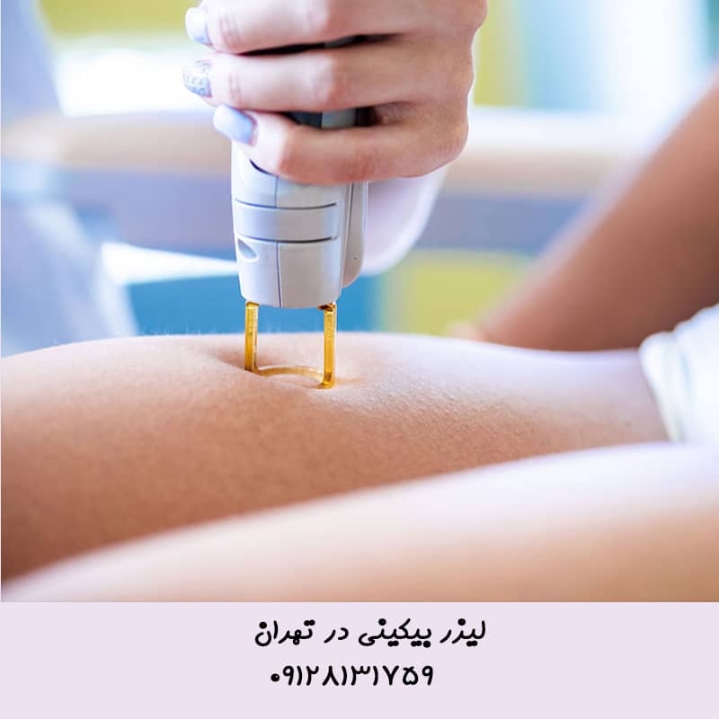 قیمت لیزر بیکینی در تهران