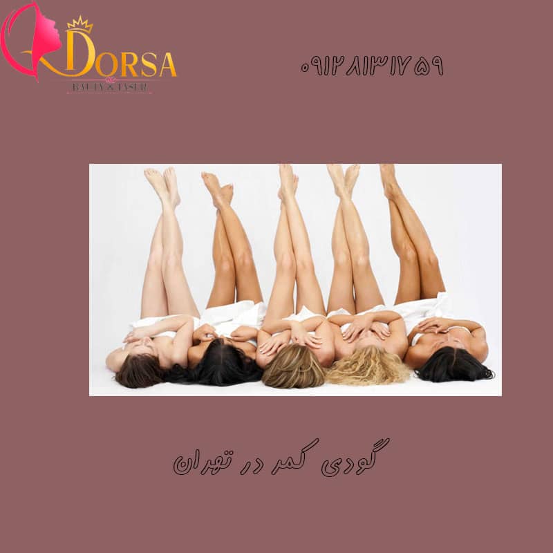 لیزر گودی کمر