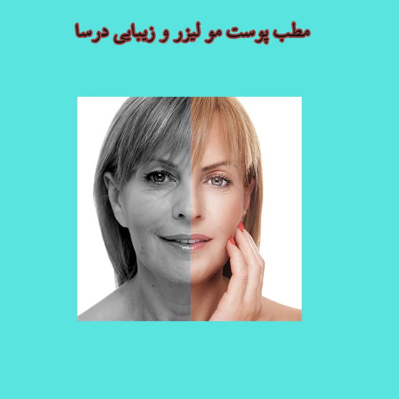 مزوتراپی صورت در منطقه 3