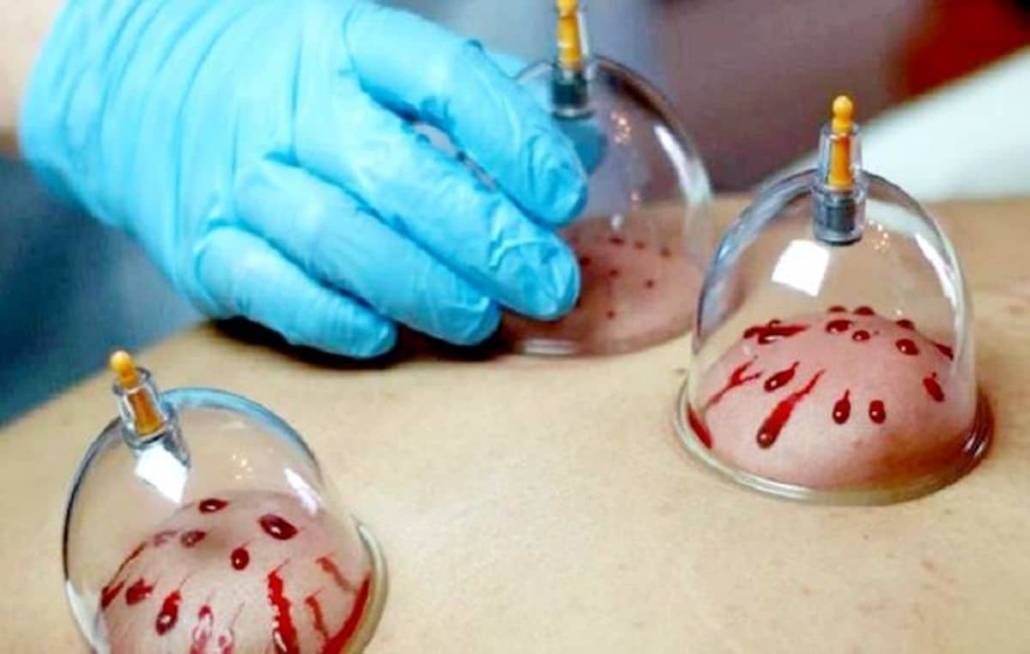 حجامت صورت | کلینیک زیبایی درسا