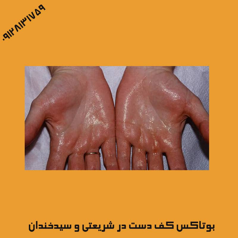 درمان عرق کف دست با بوتاکس | کلینیک زیبایی درسا