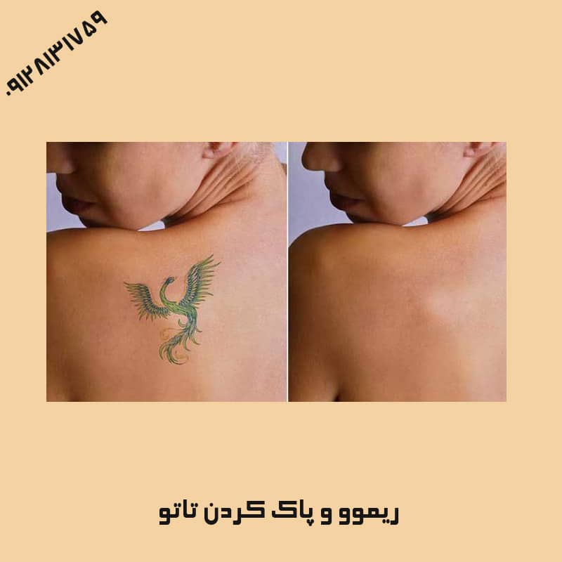 طرز استفاده از ریموور تاتو | کلینیک زیبایی درسا