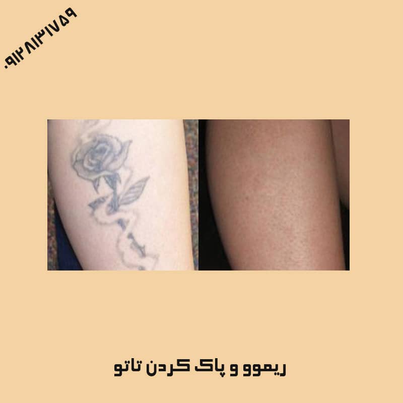 بهترین مارک ریموور تاتو | کلینیک زیبایی درسا