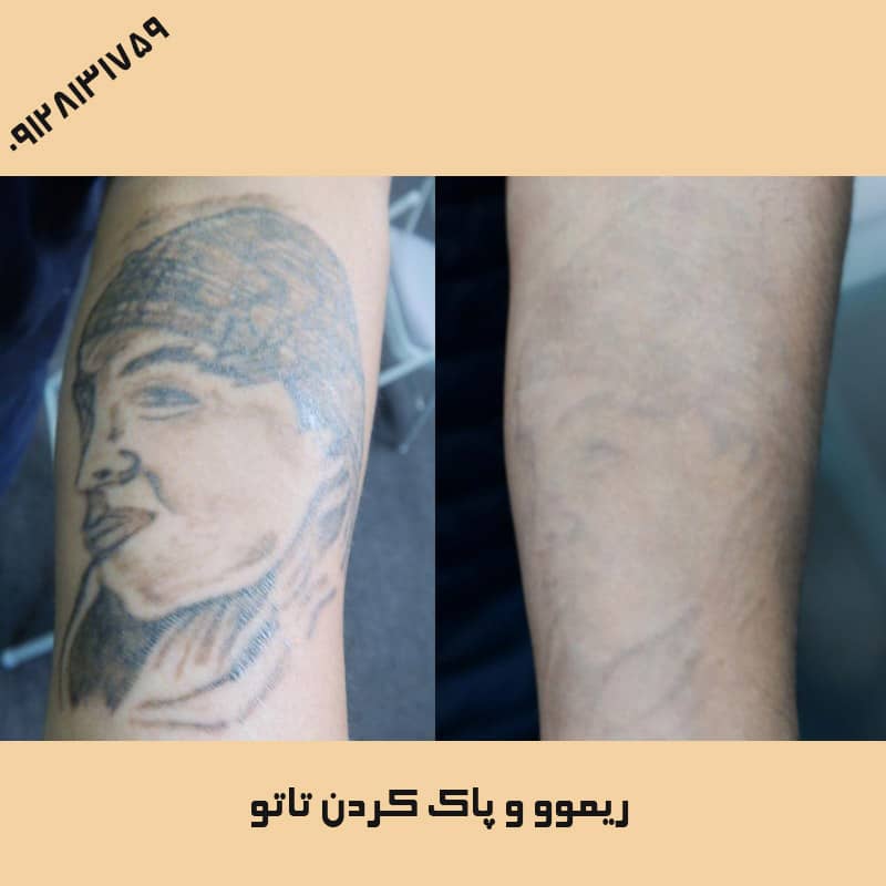 عوارض ریموور تاتو | کلینیک زیبایی درسا