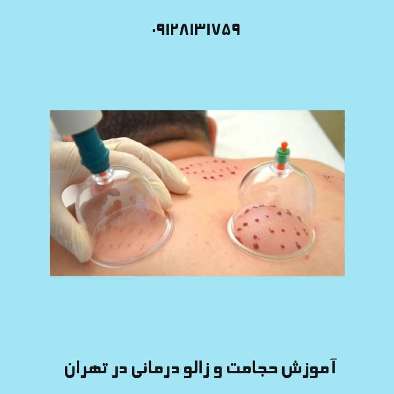 حجامت برای جوش صورت | کلینیک زیبایی درسا