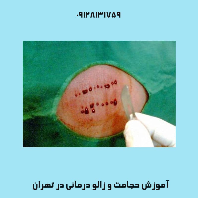 فواید حجامت صورت | کلینیک زیبایی درسا