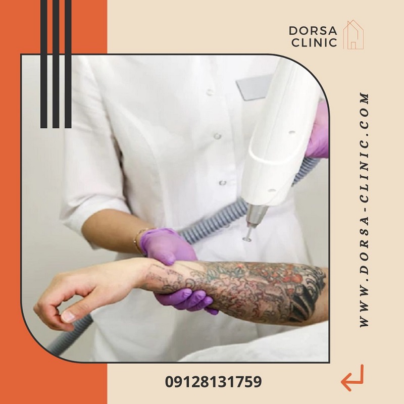 پاک کردن فوری تتو | کلینیک زیبایی درسا