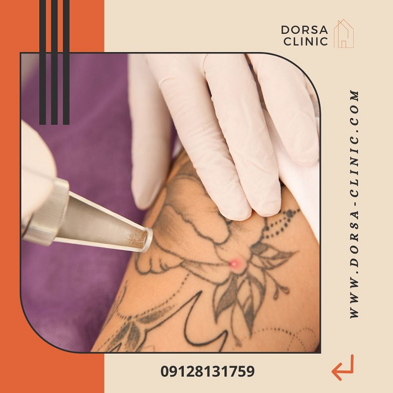 پاکسازی خالکوبی با لیزر | کلینیک زیبایی درسا