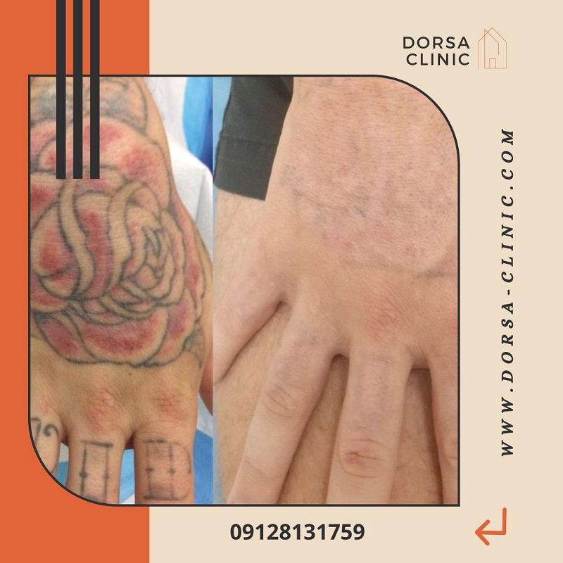 درمان تتو با لیزر | کلینیک زیبایی درسا