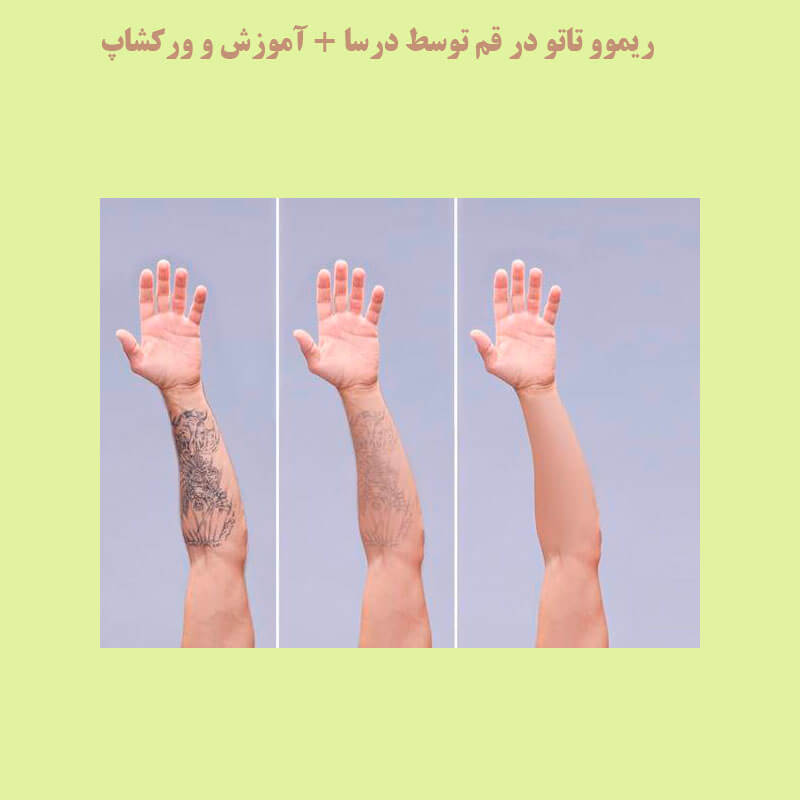 ریمو تاتو در جعفریه | کلینیک زیبایی درسا