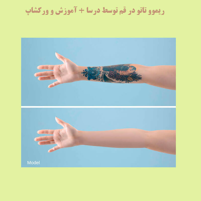 ریمو تاتو در پردیسان | کلینیک زیبایی درسا