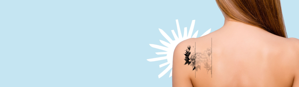 ریمو تاتو در حسن آباد | کلینیک زیبایی درسا