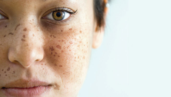 از بین بردن سریع لک صورت