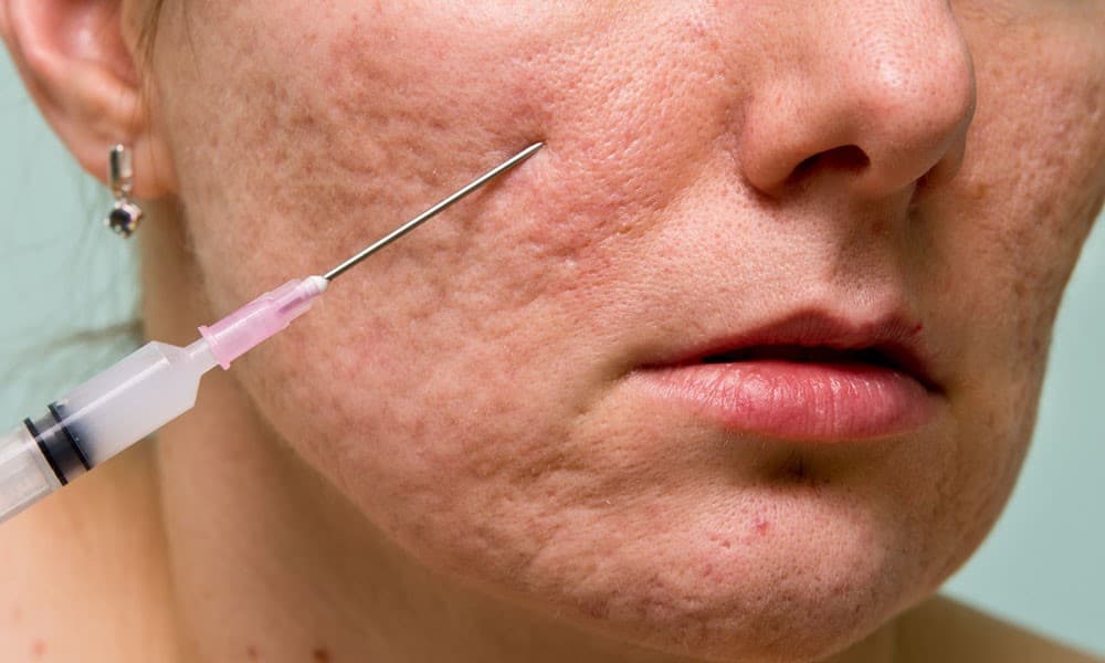 سابسیژن جای جوش