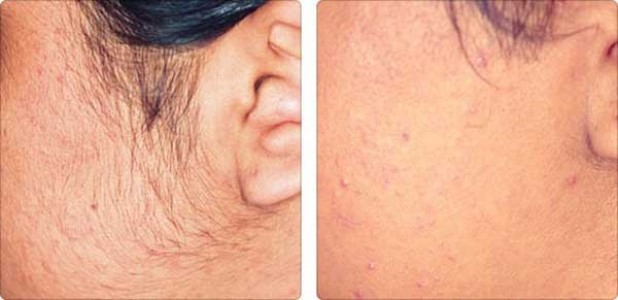 لیزر مو های زائد صورت چگونه انجام می پذیرد ؟