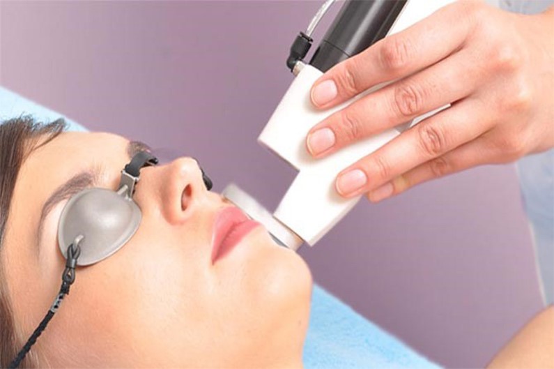 آیا لیزر مو‌های زائد صورت تنها برای خانم ها کاربرد دارد ؟