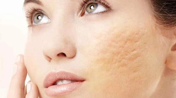 سابسیژن جای جوش : انواع سوزن سابسیژن جای جوش