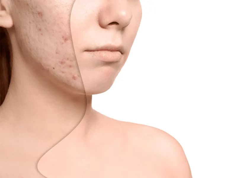 سابسیژن جای جوش : مراقبت های بعد از سابسژن جای جوش