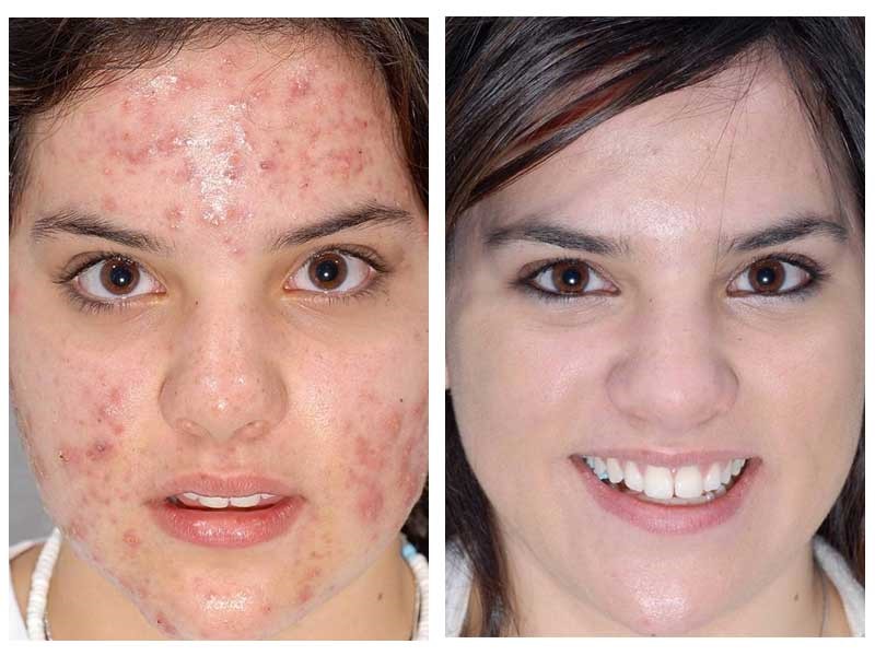 میکرودرم بیشتر برای چه افرادی مناسب است؟ میکرودرم بیشتر برای چه افرادی مناسب است؟