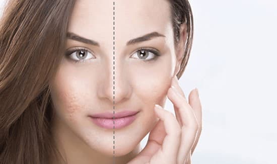 سابسیژن جای جوش