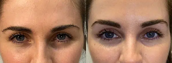 لیفت ابرو با بوتاکس چیست؟