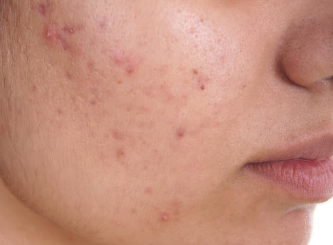 دلیل وجود جوش و آکنه برروی پوست چیست!