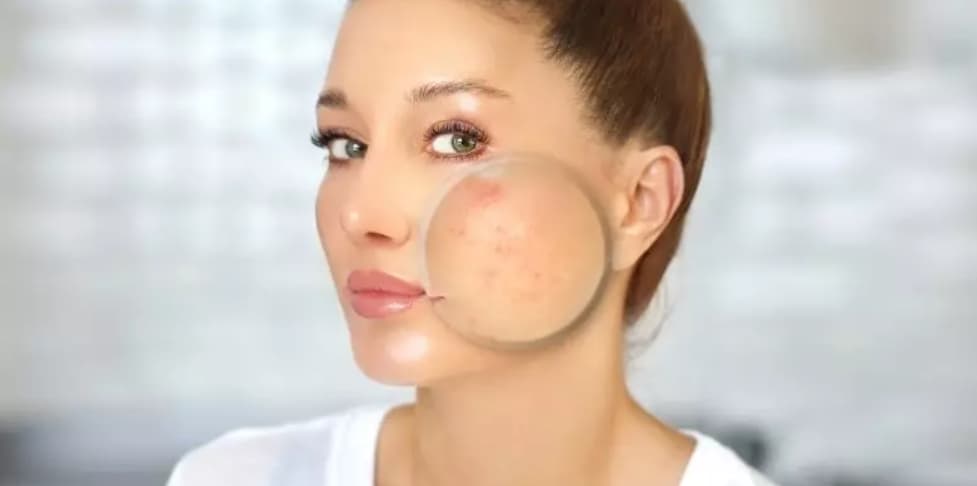 جوش های صورت