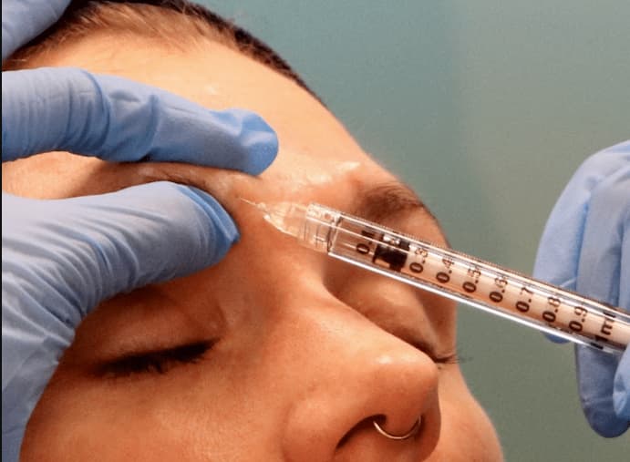 مراقبت پیش از تزریق ژل خط اخم ؛