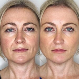 آموزش لیفت صورت با نخ در تهران