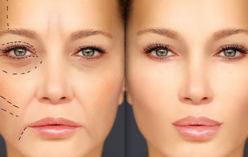 آموزش لیفت نخ در کیش