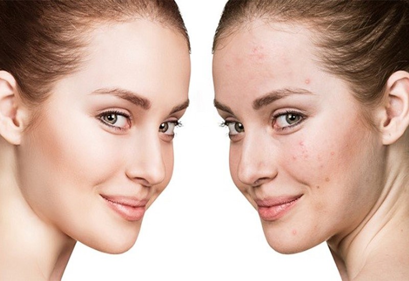 قیمت آموزش مزوتراپی در همدان چقدر است ؟