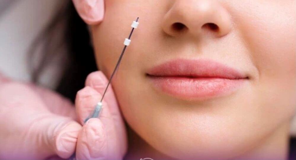 آموزش لیفت نخ در آمل آموزش لیفت نخ در آمل-وب سایت درسا کلینیک