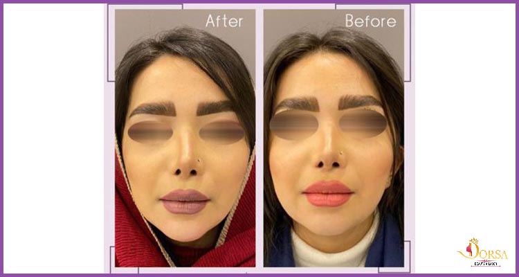 آموزش تزریق فیلر در مشهد