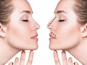 اصلاح فرم بینی بدون جراحی چگونه است ؟