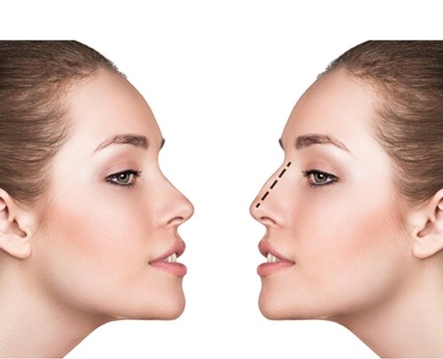 مراقبت‌های لازم پس از انجام اصلاح فرم بینی