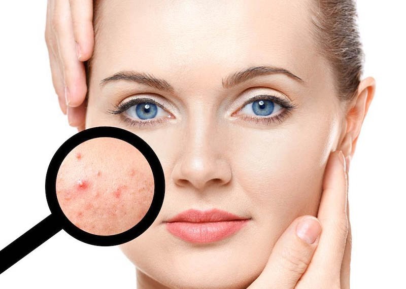  زخم آکنه چیست ؟