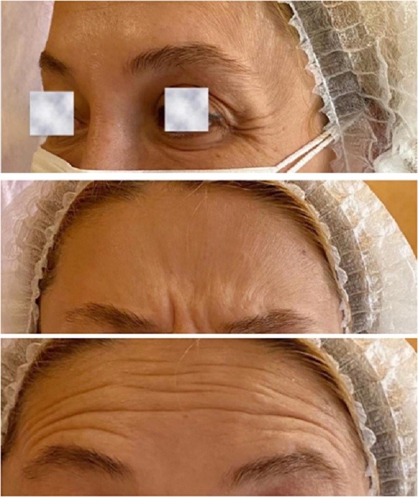 تزریق بوتاکس چیست ؟