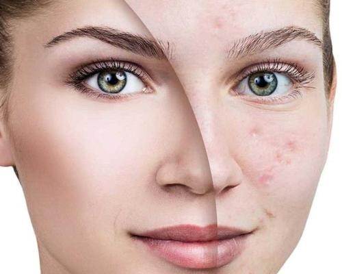 رهایی از زخم های ناشی از آکنه