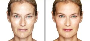 چگونه می توان از چین و چروک پیشانی خلاص شد ؟