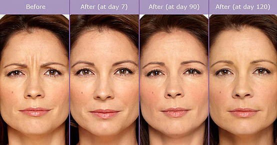 اثر بوتاکس بعد از چند روز شروع می شود ؟