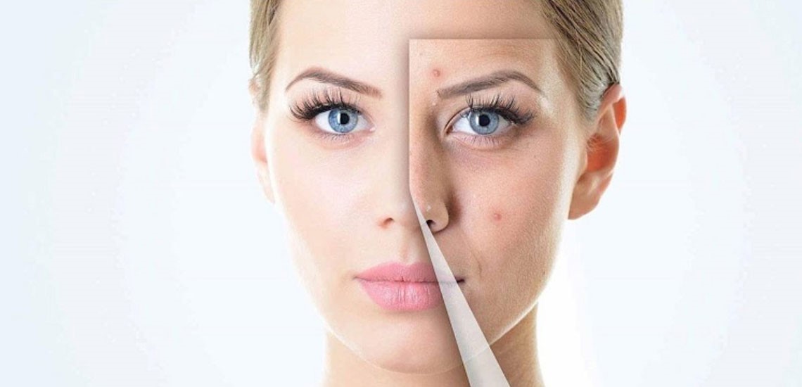 رهایی از زخم های عمیق ناشی از آکنه