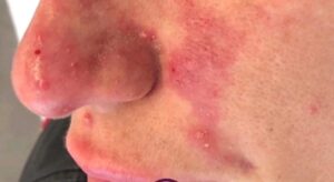 ۸ عارضه احتمالی مربوط به لیفت با نخ و چگونگی حل آن