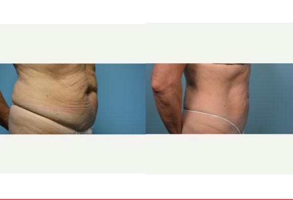 منظور از ترماژ ( Thermage ) چیست ؟