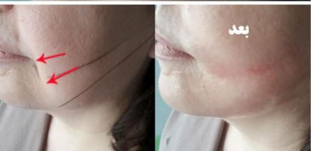 چگونه به رفع عوارض لیفت نخ کمک کنیم ؟ چگونه به رفع عوارض لیفت نخ کمک کنیم ؟