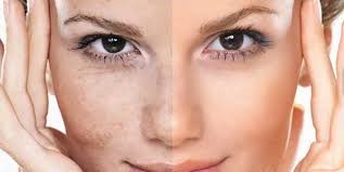 استفاده از لیزر تراپی برای سفتی پوست