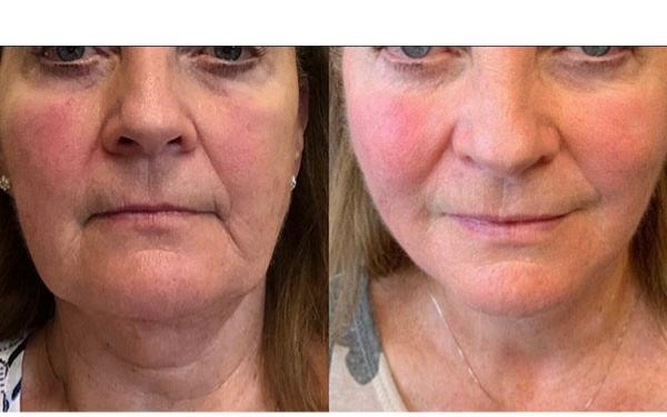 نکات بهداشتی جهت انجام لیفت نخ نکات بهداشتی جهت انجام لیفت نخ